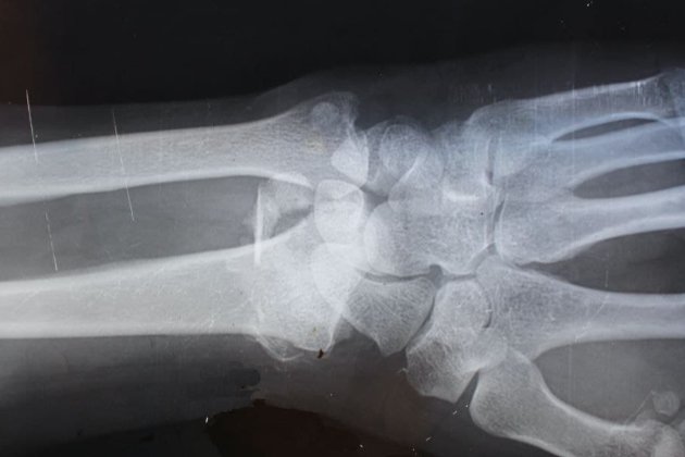 У Франції хірург намагався продати рентгенівський знімок жертви теракту в «Батаклані» як NFT