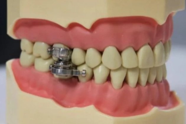 Новозеландські вчені запропонували худнути за допомогою магнітного замку на зубах 
